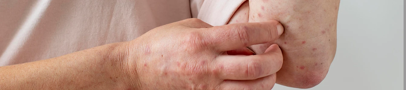 Psoriasis