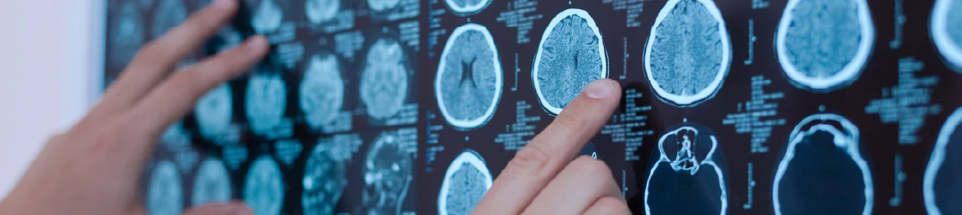 Medulloblastoma